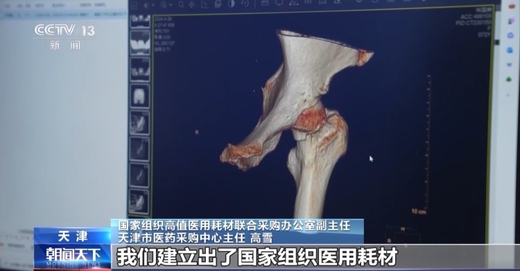 人工关节集采两年来 全国共使用集采人工关节超111万套