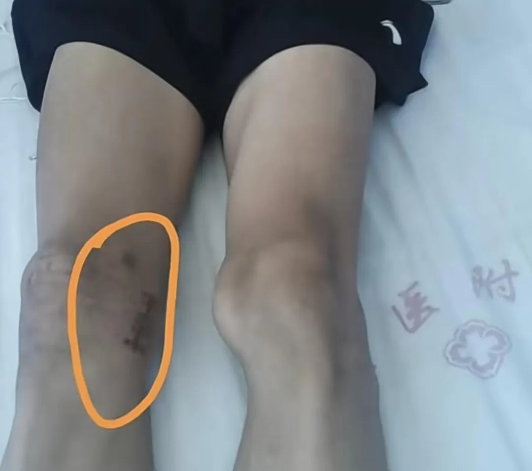 体育生左膝长骨瘤医生错切右膝!医院通报:6人被处理 体育生左膝长骨瘤医生错切右膝!医院通报:6人被处理