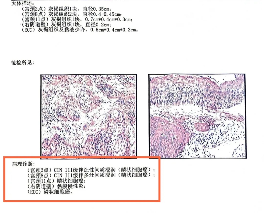 不痛不痒！女子竟查出癌症：难以接受！