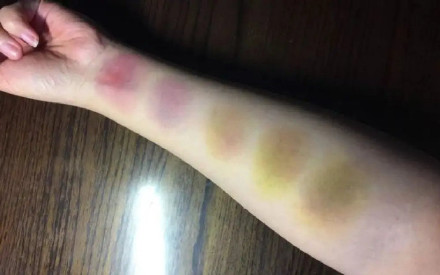 淤青痊愈前为什么会变色 淤青痊愈前为什么会变色