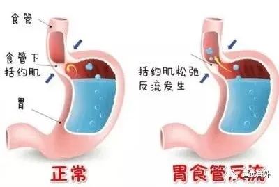 为什么说“病”在胃,却“险”在肺? 为什么说“病”在胃,却“险”在肺?