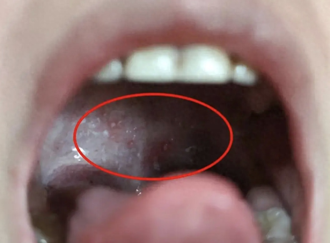 发烧、嗓子疼,警惕这两种疾病—— 发烧、嗓子疼,警惕这两种疾病——