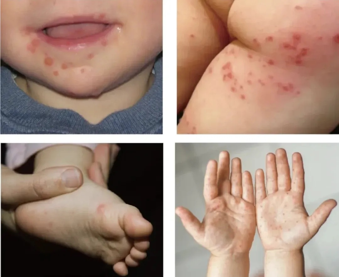 中疾控预警：这种病毒存在暴发风险