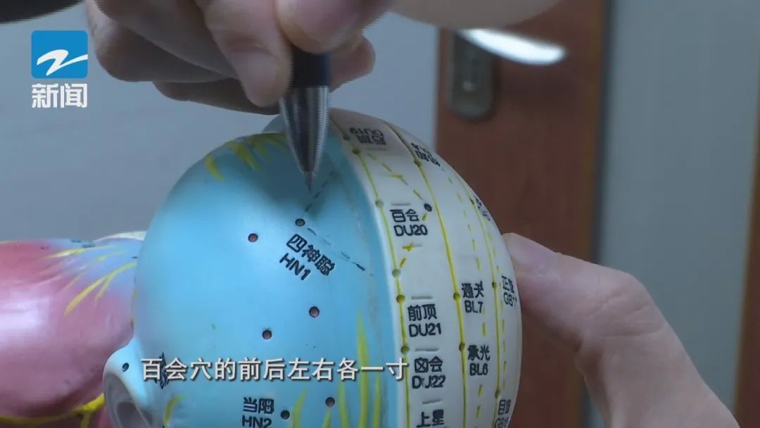 针灸能让人变聪明？浙江一医院开设了这样的门诊→