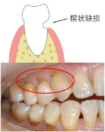 拉锯式刷牙时间久了会怎样