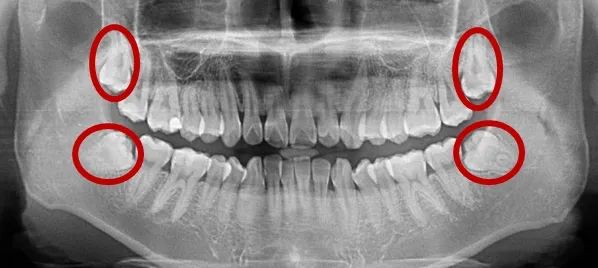 智齿,一定要拔吗? 智齿,一定要拔吗?