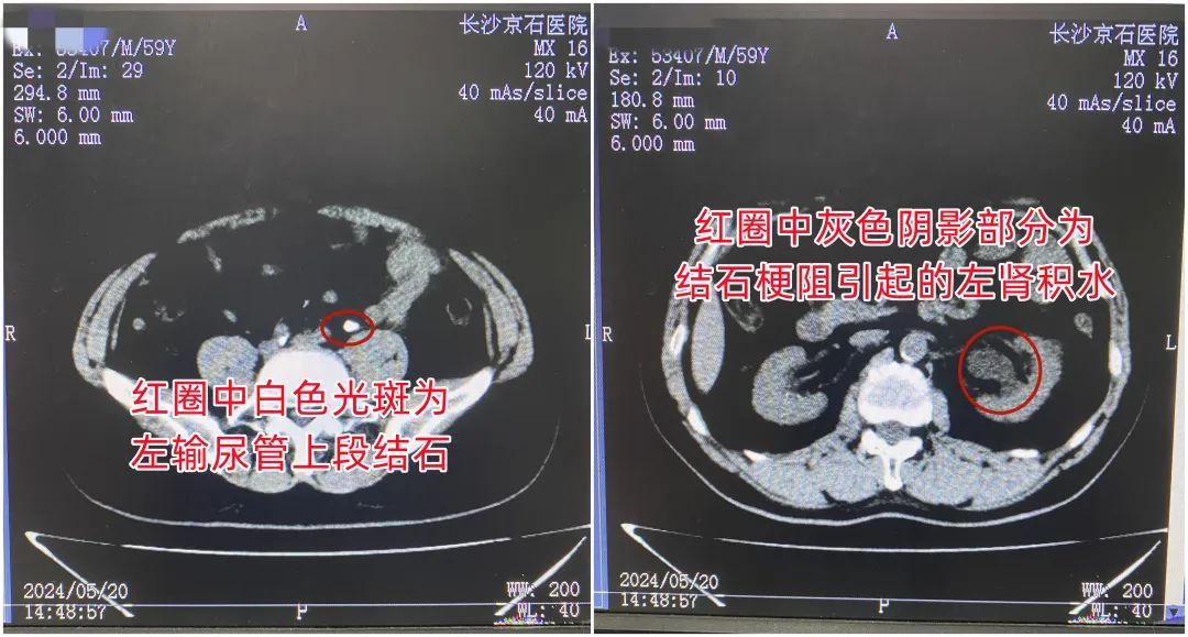 男子突发左腰胀痛伴血尿，连做3次体外碎石无效方紧急就医