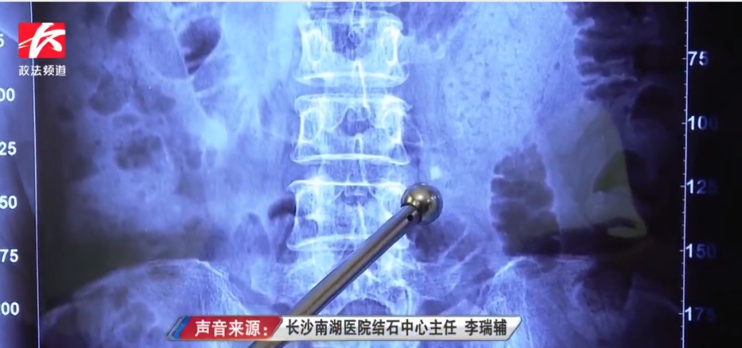 夏天这件事很重要！29岁程序员中招了