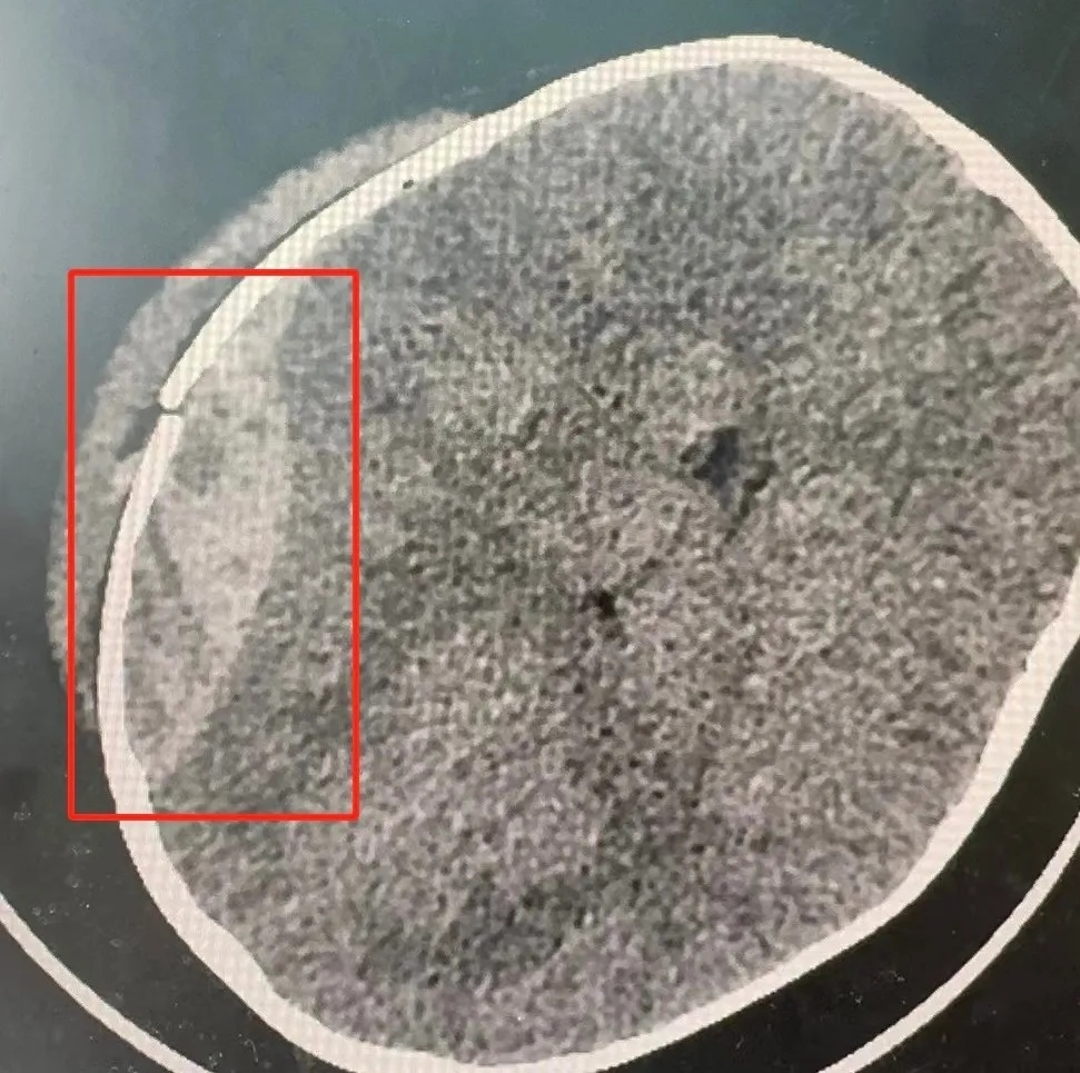 太危险!3岁幼儿从二楼阳台坠落,一度出现哭闹、嗜睡、呕吐症状 太危险!3岁幼儿从二楼阳台坠落,一度出现哭闹、嗜睡、呕吐症状