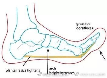 足底筋膜炎患者怎么选鞋子？