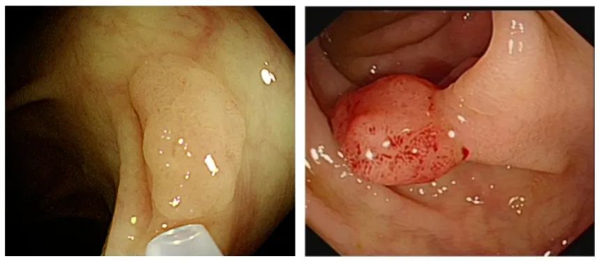 5毫米的小息肉,多年潜伏竟成癌!医生:一个方法就能避免→ 5毫米的小息肉,多年潜伏竟成癌!医生:一个方法就能避免→
