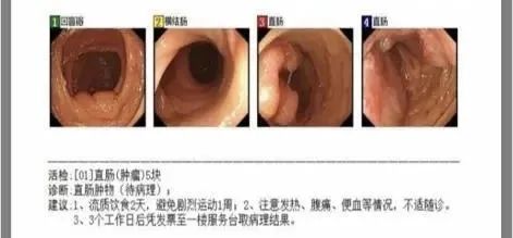 5毫米的小息肉,多年潜伏竟成癌!医生:一个方法就能避免→ 5毫米的小息肉,多年潜伏竟成癌!医生:一个方法就能避免→