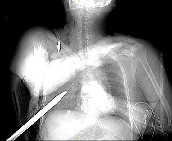 突发！台州一男子4米高空坠落，15厘米的錾子刺入胸腔……