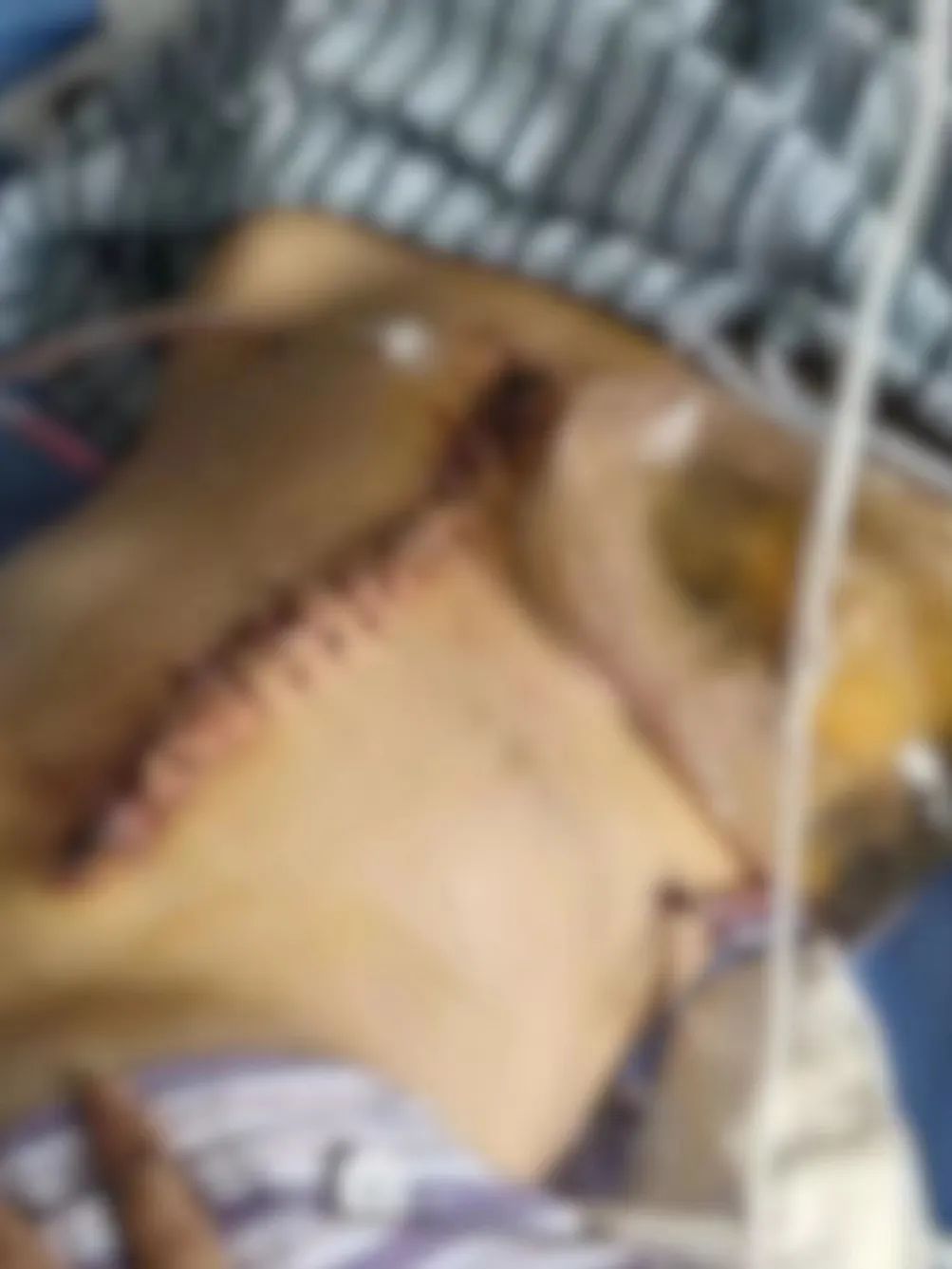 法院判了！女子称2年被家暴16次，需终身挂粪袋生活