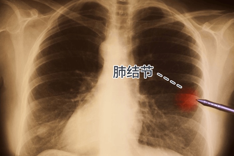体检查出结节、囊肿、息肉，意味着什么？需要治疗吗？一文说清