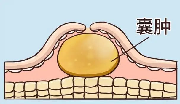 体检查出结节、囊肿、息肉，意味着什么？需要治疗吗？一文说清