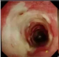 大伯干活回家，突然倒地窒息！气管发霉了？很多人都有同一个爱好…