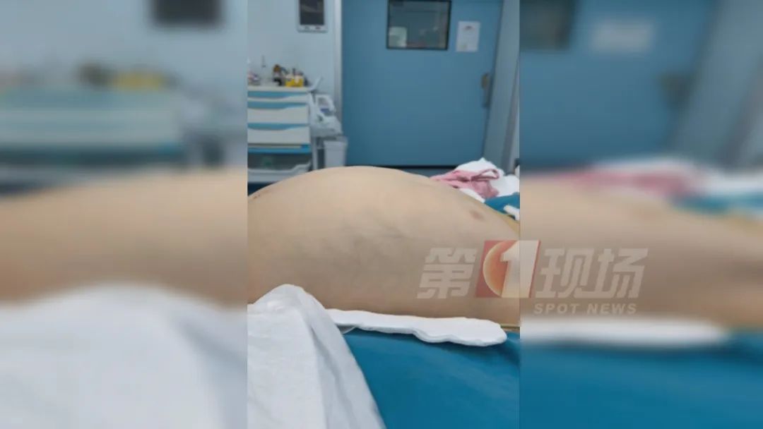 八岁娃得罕见病，肚大似孕妇！竟是20厘米巨大肿瘤……