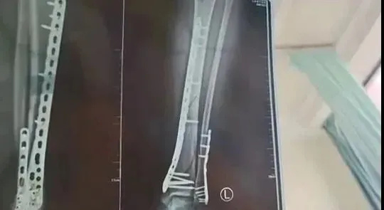 有人摔成粉碎性骨折！“又土又丑”却翻红卖爆，医生紧急提醒