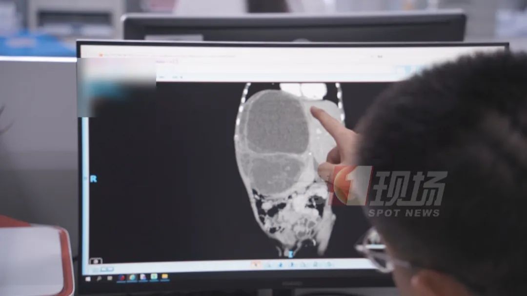 八岁娃得罕见病，肚大似孕妇！竟是20厘米巨大肿瘤……