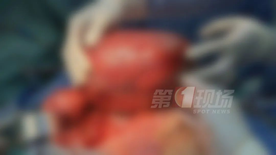 八岁娃得罕见病，肚大似孕妇！竟是20厘米巨大肿瘤……