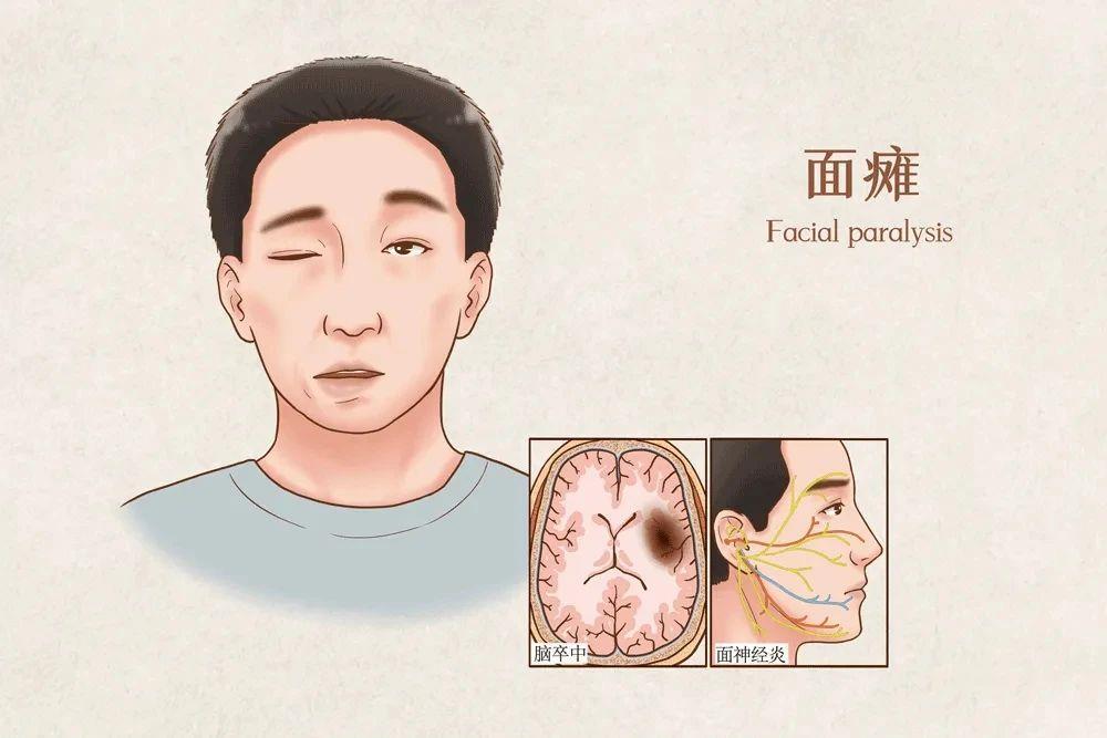 长期吹空调易诱发“面瘫” 如何预防“空调病”？