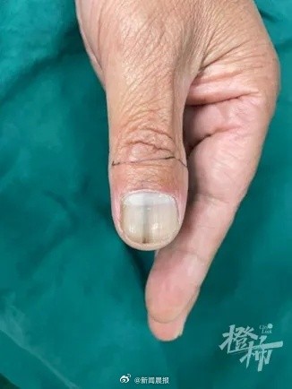 男子指甲长黑线3年没消失被确诊甲母痣，如何判断甲母痣的良恶性？