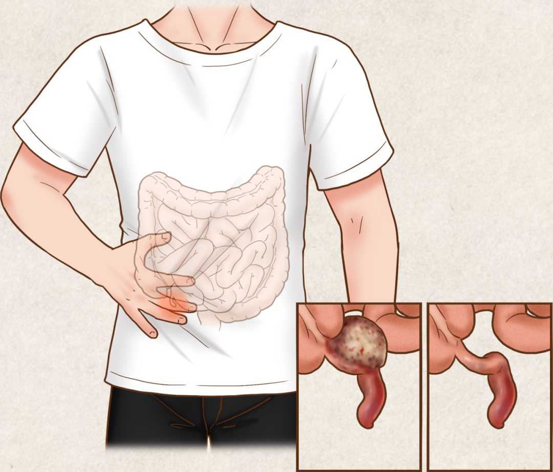 阑尾炎是“跑”出来的吗? 阑尾炎是“跑”出来的吗?