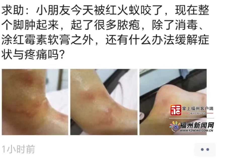 福州一女孩被咬伤！有剧毒！严重会致命！