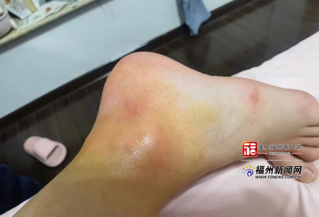 福州一女孩被咬伤！有剧毒！严重会致命！