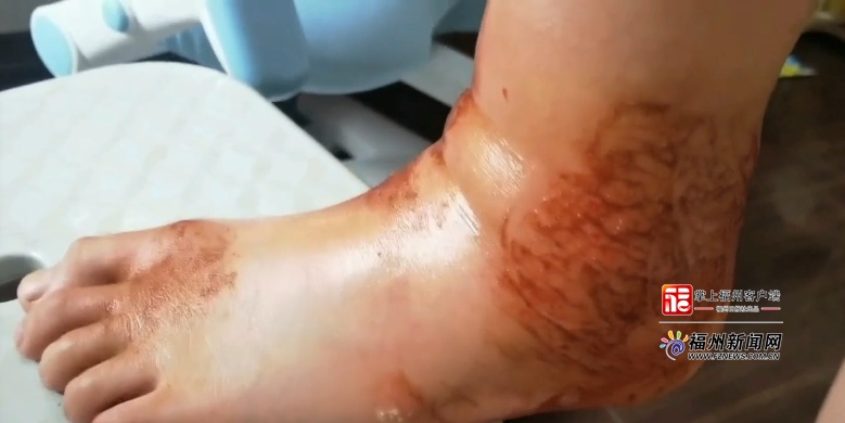 福州一女孩被咬伤！有剧毒！严重会致命！