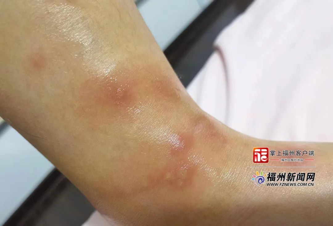 福州一女孩被咬伤！有剧毒！严重会致命！