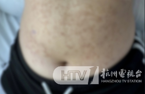 密密麻麻!2人跟风网红减肥法,竟患上这种皮肤病……医生提醒→ 密密麻麻!2人跟风网红减肥法,竟患上这种皮肤病……医生提醒→