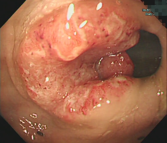 警惕!绍兴市人民医院,已出现1例 警惕!绍兴市人民医院,已出现1例