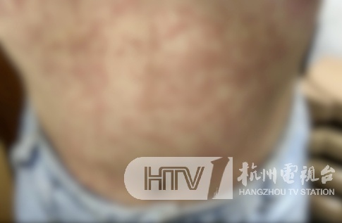 密密麻麻!2人跟风网红减肥法,竟患上这种皮肤病……医生提醒→ 密密麻麻!2人跟风网红减肥法,竟患上这种皮肤病……医生提醒→