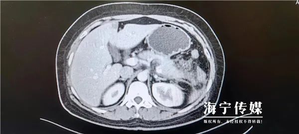 突然剧痛！女子饭后紧急送医，已中招3次…端午节前后高发