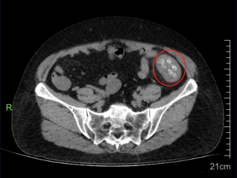 这里已出现1例!警惕,进入高发期! 这里已出现1例!警惕,进入高发期!