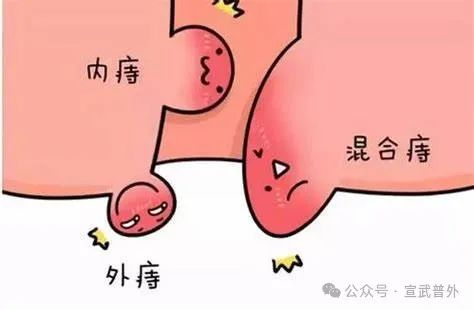 痔在身体,疮在心里 痔在身体,疮在心里