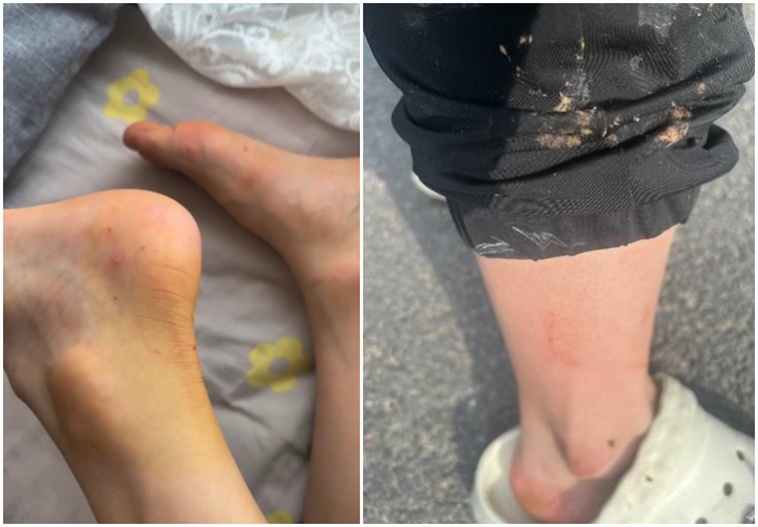 恶狗咬伤六人，包括4名儿童！孩子母亲讲述惊险一幕