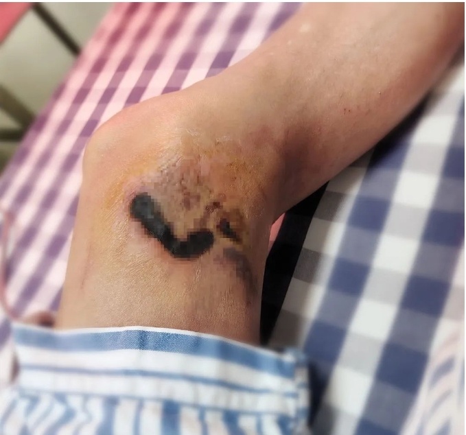 已到高发期,多人中招!曾有人因此丧命…… 已到高发期,多人中招!曾有人因此丧命……