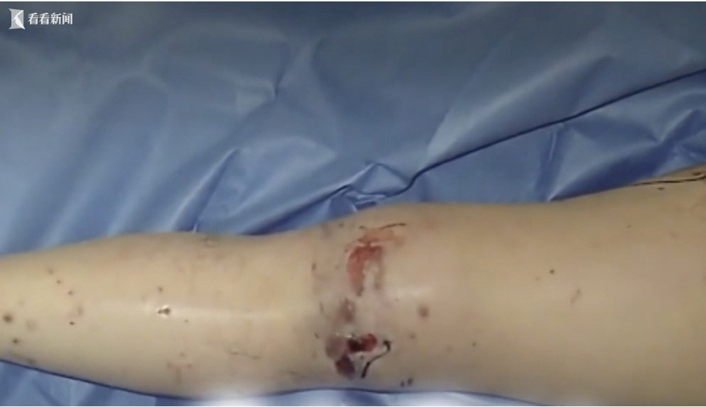 “食人菌”疯传！手脚坏死，截肢保命，口罩防得住吗？