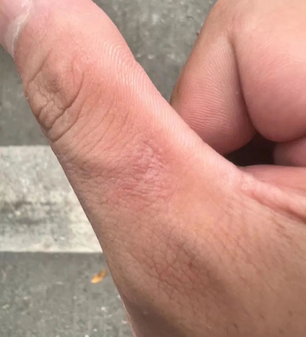 被羊咬了一口,深圳男子反复高烧不退,病因原来是→ 被羊咬了一口,深圳男子反复高烧不退,病因原来是→