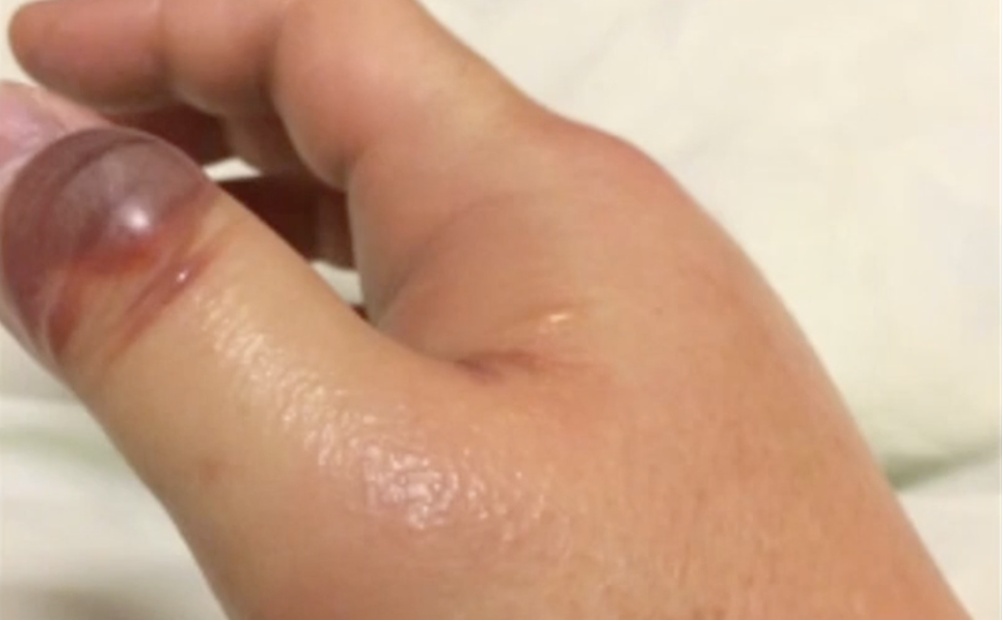 “食人菌”疯传！手脚坏死，截肢保命，口罩防得住吗？