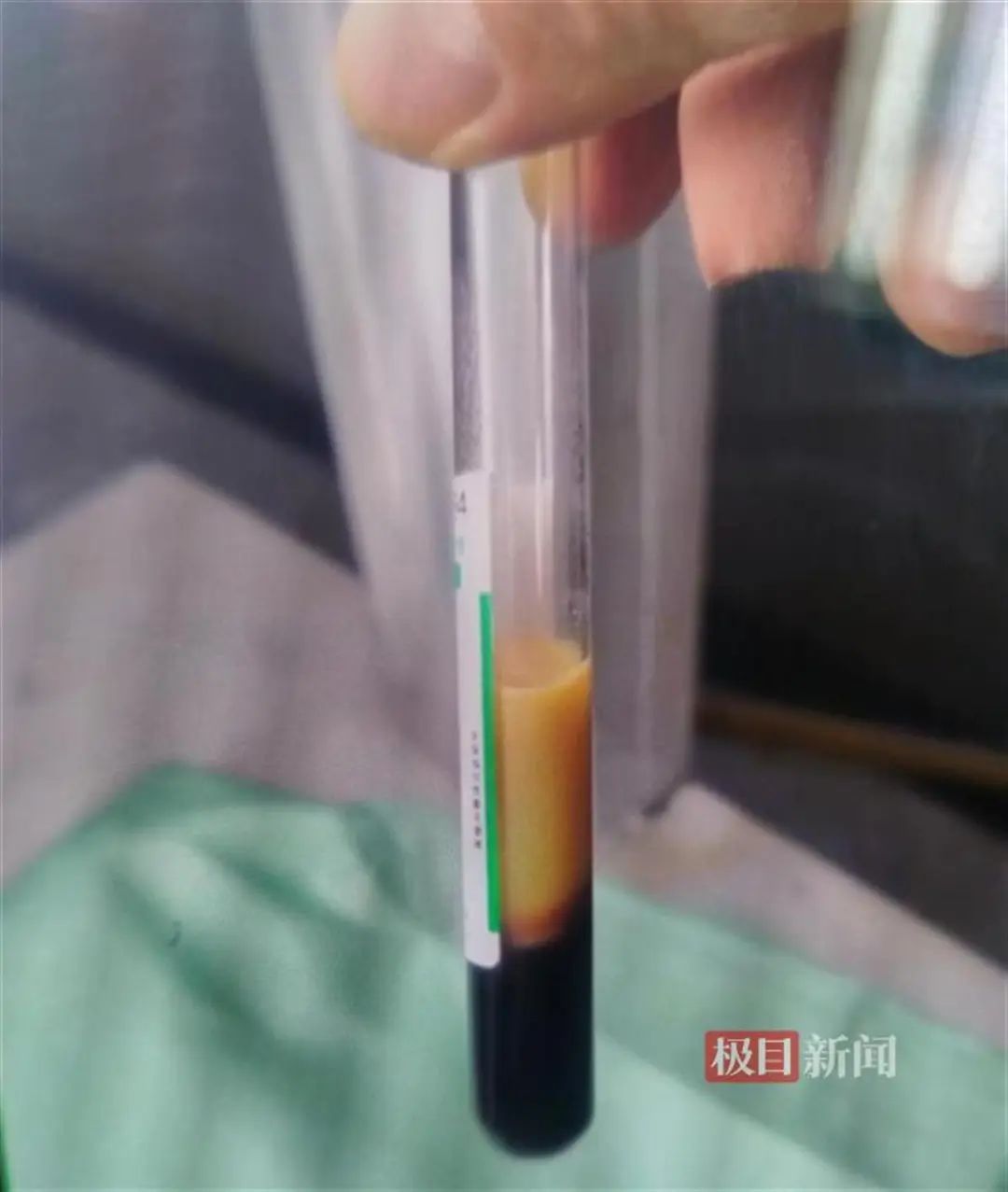 一管血里半管“油”，男子血脂竟是正常人的40倍