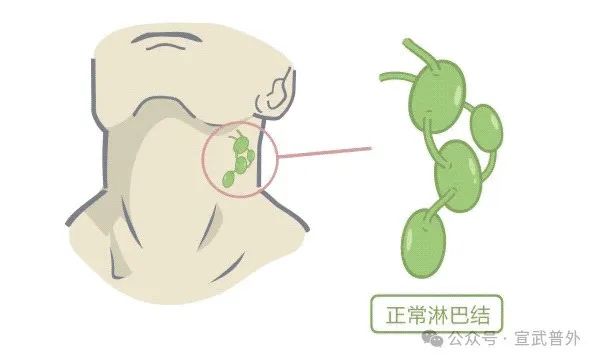 耻骨巨痛，原来淋巴结惹的祸