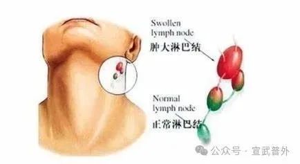 耻骨巨痛，原来淋巴结惹的祸