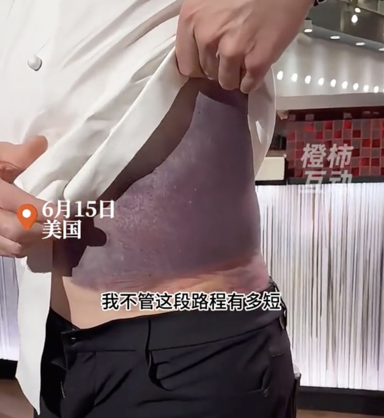 差点没命！顶级厨神突发意外，掀开衣服时吓坏众人......