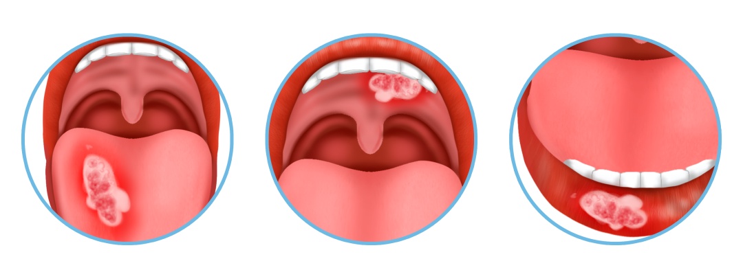 别把口腔溃疡不当回事