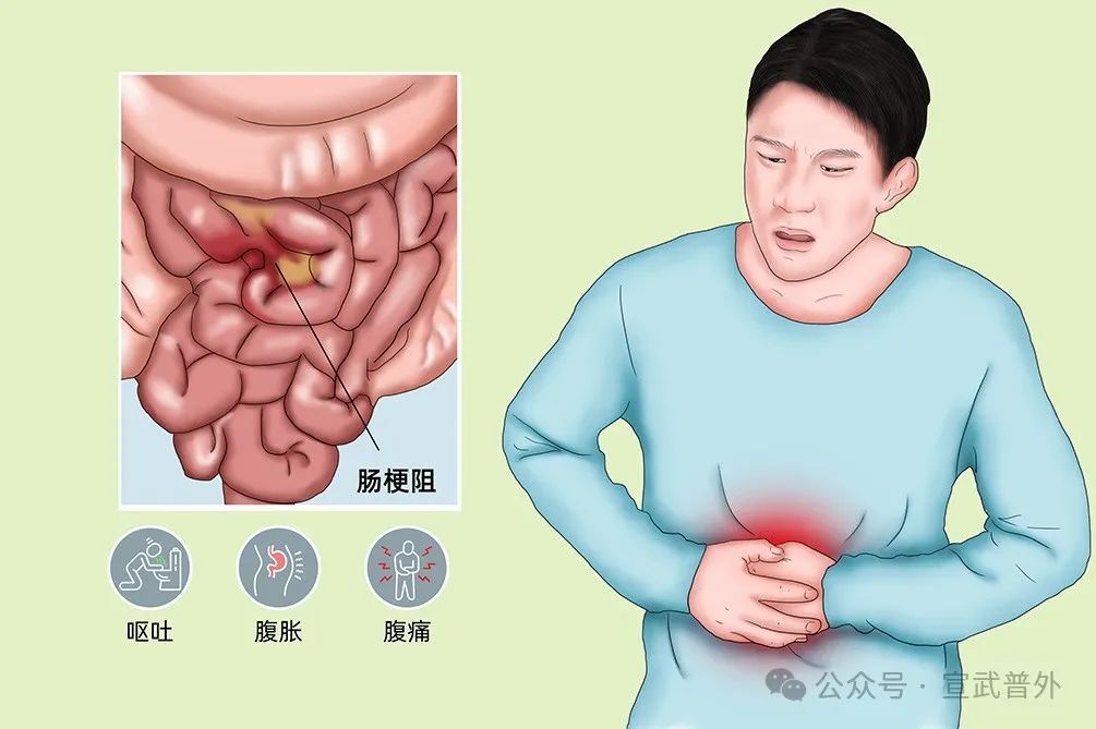 肠梗阻要做手术吗？