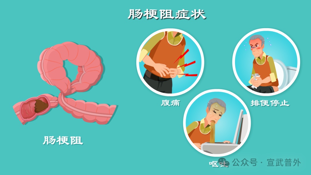 肠梗阻要做手术吗? 肠梗阻要做手术吗?